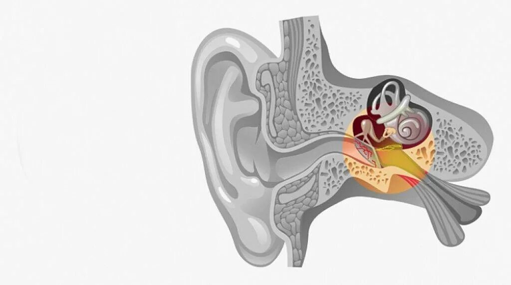 Внутреннее ухо лечение и симптомы. Менингогенный лабиринтит. Гематогенный лабиринтит. Сифилитический лабиринтит. Воспаление среднего уха (лабиринтит);.