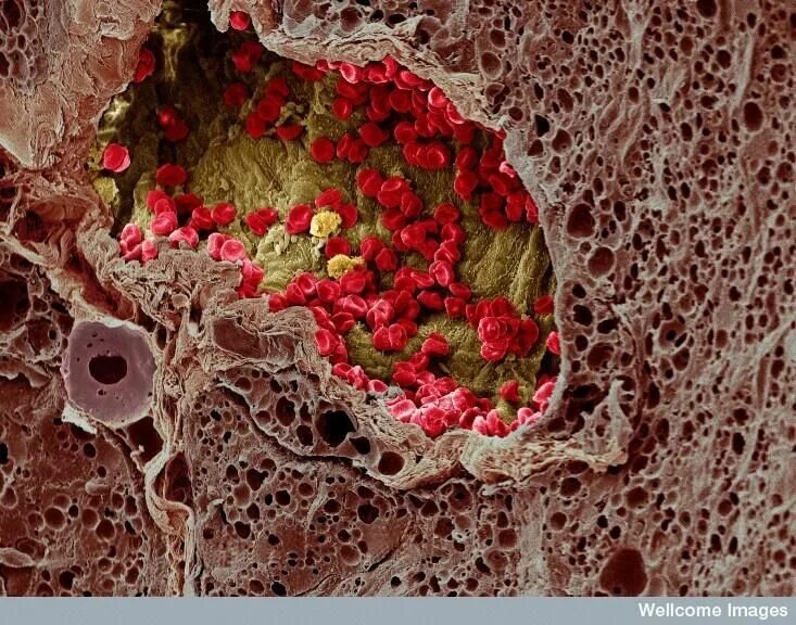 Scans reveal colours of cancer cells and body's defence Daily Mail Online