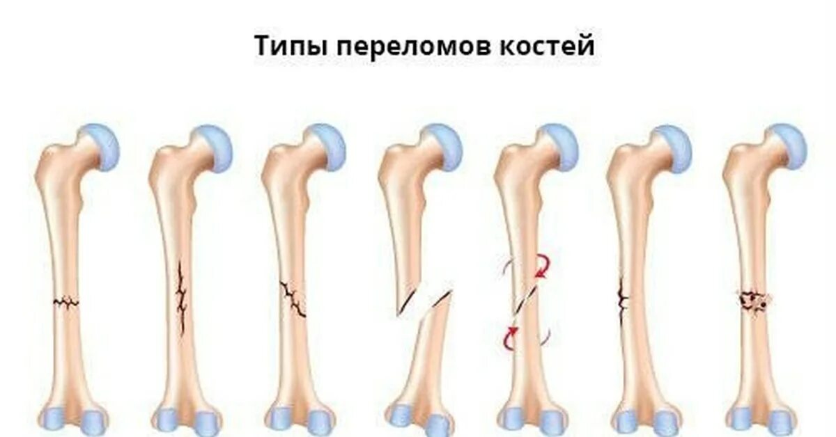 Перелома кости: по виду смещения отломков. Типы переломов трубчатых костей.