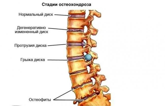 Спондилёз пояснично-крестцового отдела l1 l2. Спондилез 2 степени поясничного отдела позвоночника. Остеохондроз спондилез спондилоартроз. Пояснично крестцовый спондилоартроз l1-s1.