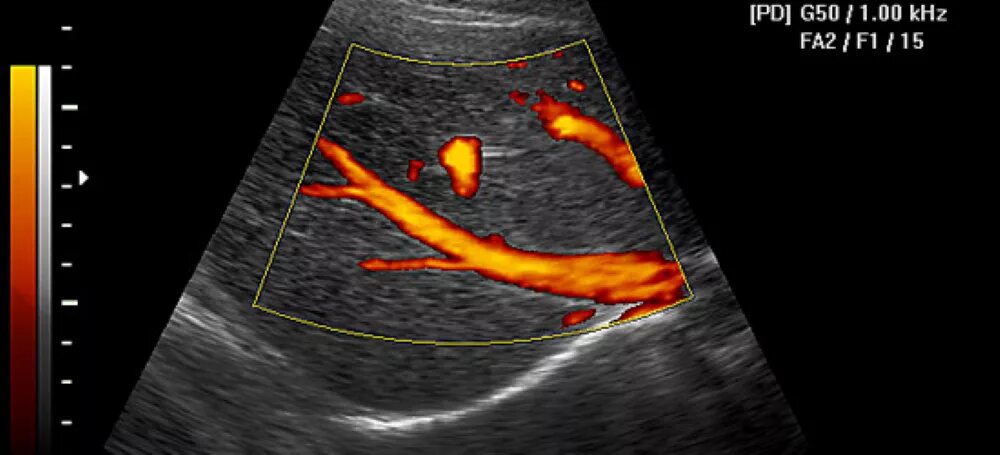 Доплер кровотоки. Энергетический доплер в УЗИ. Ультразвуковая допплерография маточно-плацентарного кровотока. Допплерография сосудов брюшной полости. УЗДГ – ультразвуковая допплерография сосудов.