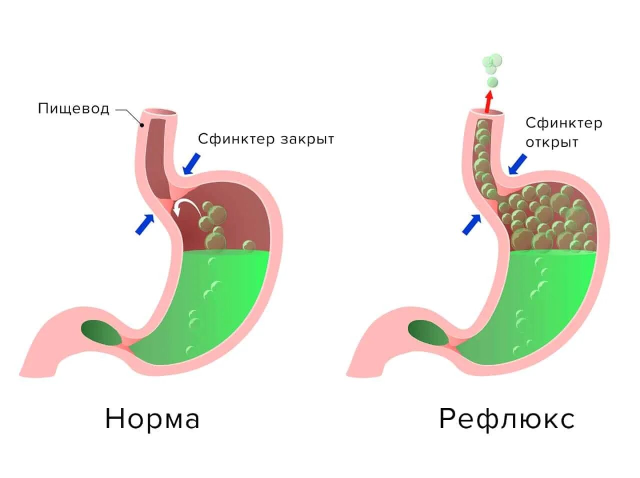 Кислый рефлюкс. Гастроэзофагеальная рефлюксная болезнь желудка. гастроэзофагеальной рефлюксной болезни.