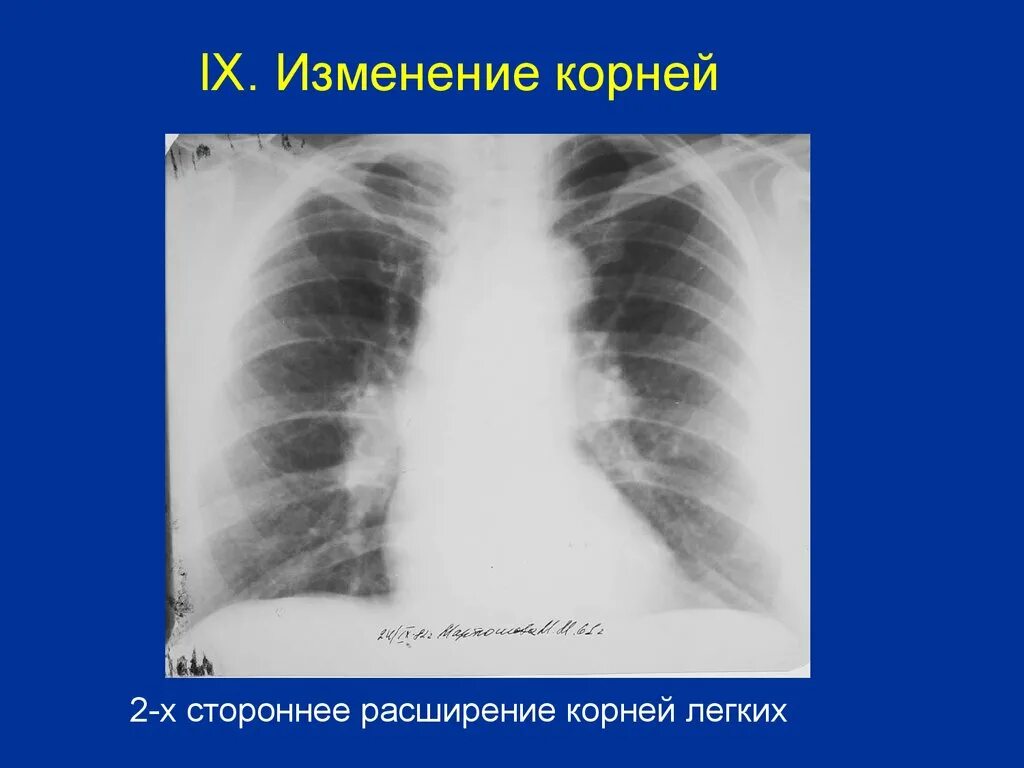 Изменения корня легкого. Синдром патологии корня легкого рентген. Расширение корня легкого на рентгене.