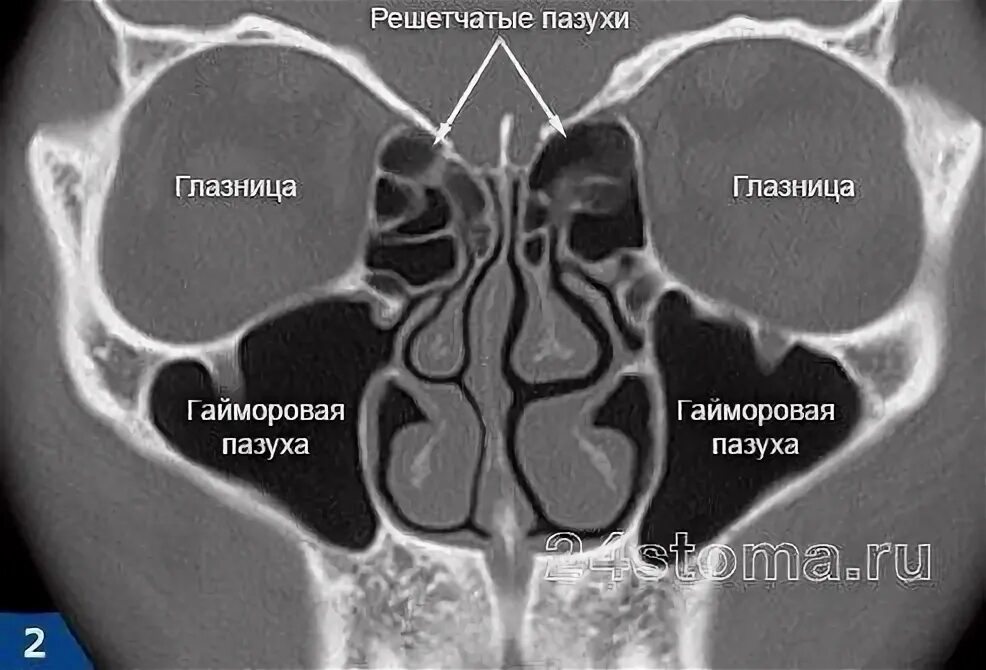 Хронический сфеноидит. Воспаление решетчатой пазухи на рентгене. Гайморит верхнечелюстной пазухи кт. Хронический сфеноидит на кт.