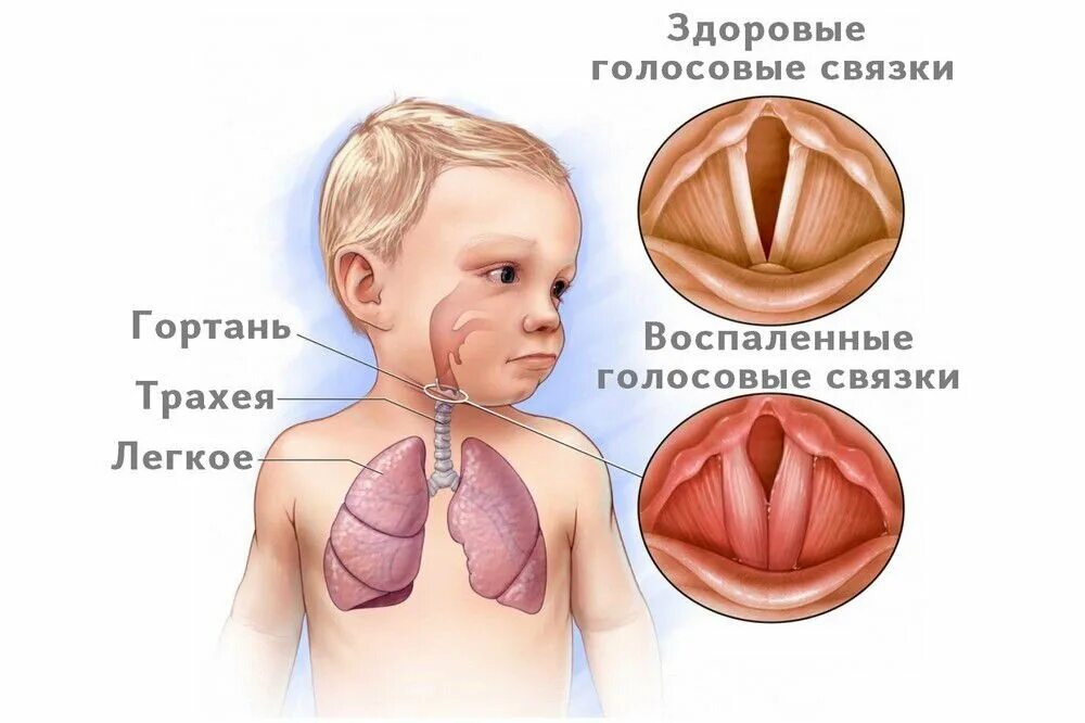 Что такое круп у детей. Острый обструктивный ларингит круп. острый обструктивный ларингит у детей.