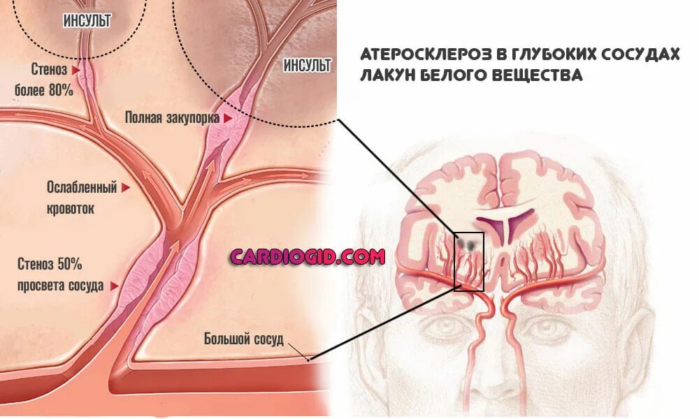 Инсульт левой артерии. Сужение сосудов головного мозга. Сужение артерий головного мозга. Стеноз сосудов головного мозга. Стеноз артерий головного мозга.