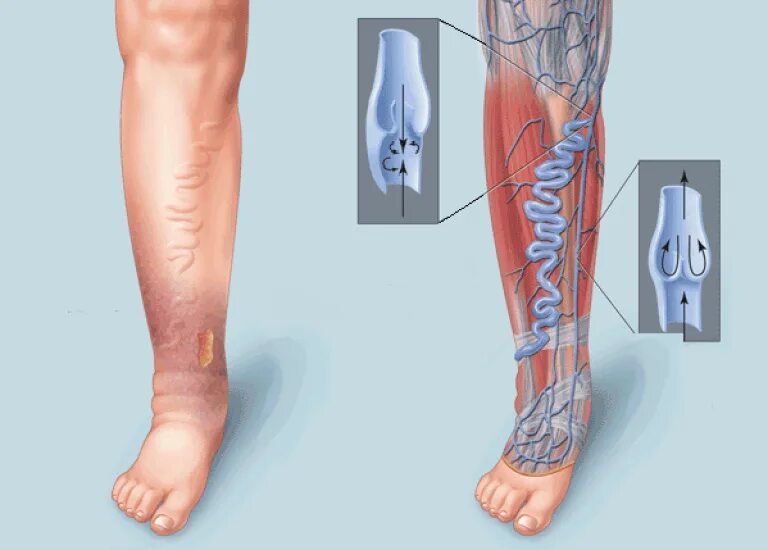 Сильно болит вена. Хроническая венозная недостаточность (ХВН). Варикозное расширение вен нижних конечностей ХВН. Варикозное расширение вен нижних конечностей ХВН с2 3s.