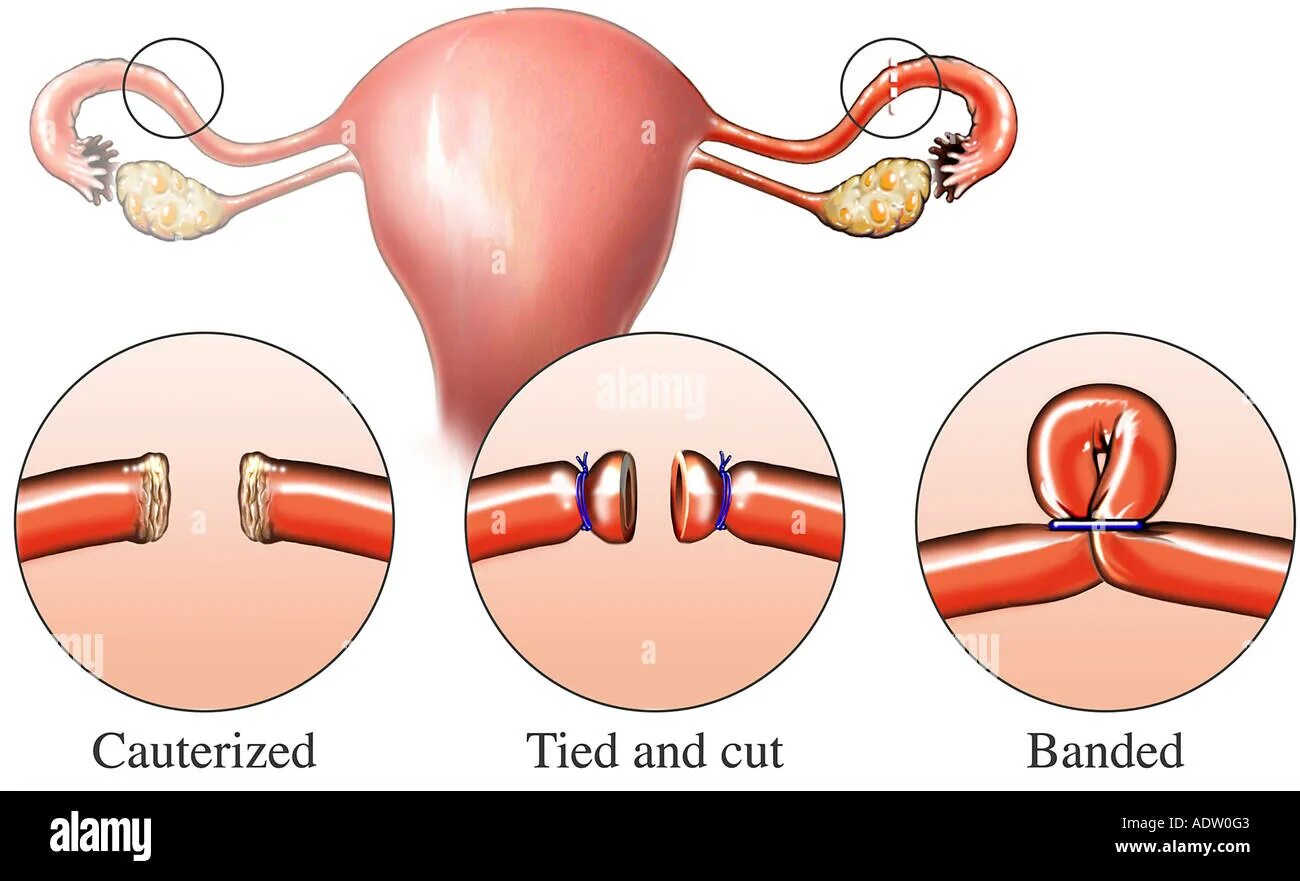 Хирургическая стерилизация маточных труб. Добровольная стерилизация маточных труб. Хирургические методы контрацепции. Перевязка труб у женщин. Если месячные если перевязать трубы