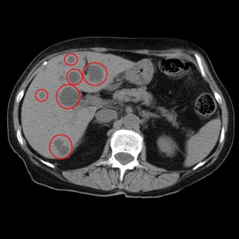 Кт брюшной полости метастазы. Метастатическое поражение печени на кт. Удаление опухолей печени