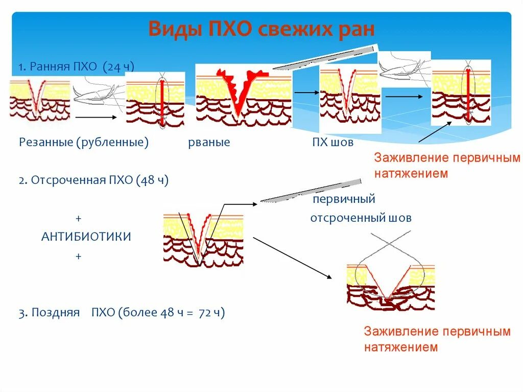 Хирургический рана гнойной. Первичная хирургическая обработка раны (Пхо). Техника проведения Пхо раны алгоритм. СОП первичная хирургическая обработка раны.