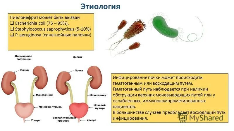 Острый пиелонефрит этиология