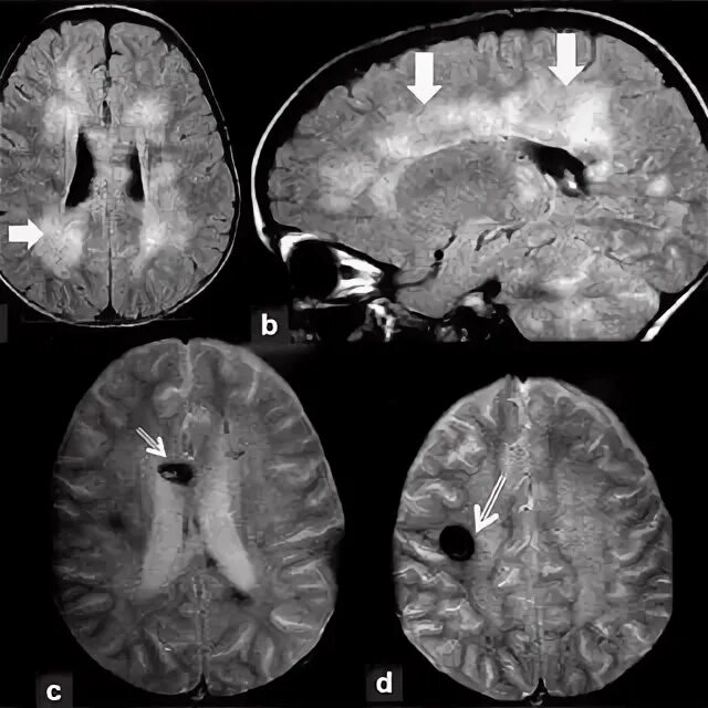 Лейкоэнцефалит. Острый геморрагический лейкоэнцефалит. лейкоэнцефалит ван богарта. подострый склерозирующий лейкоэнцефалит ван-богарта. острый геморрагический лейкоэнцефалит мрт.