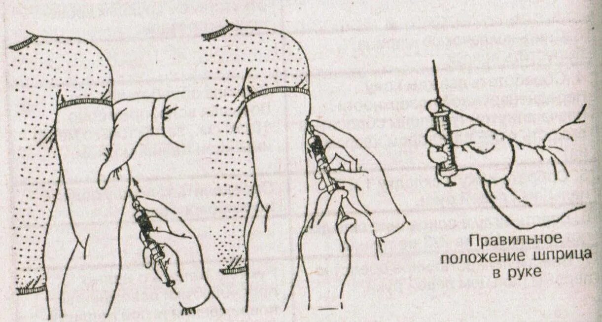 Как правильно держать шприц. Схема техника выполнения подкожной инъекции. Подкожная инъекция в плечо техника. Схема введения инъекции подкожно. Алгоритм подкожной инъекция подкожно.