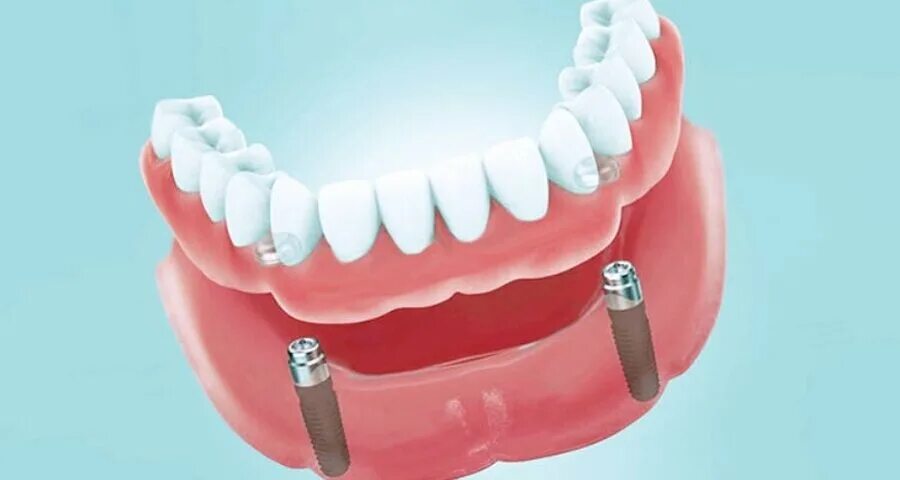 Съемный протез на имплантах Osstem. Болл Аттачменты съемный протез. Балка на имплантатах аттачмент mk1. Протез на 2 имплантатах на нижней челюсти.