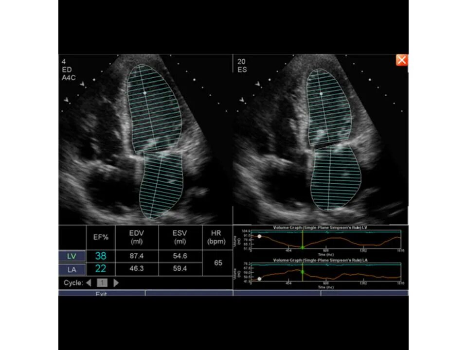 Эхо кг и эхо кс. Эхокардиография эхо кг узи сердца. Эхокардиография эхо кг сердца что это. Контроль эхо кс что это. Эхо кс.