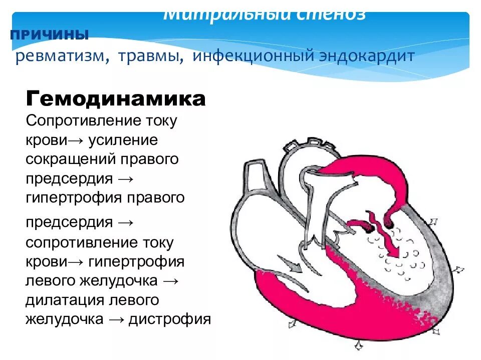 Причины расширения полости левого предсердия и правого желудочка. Митральная недостаточность сердце. Митральный стеноз гипертрофия правого желудочка. Митральная недостаточность гемодинамика схема. Дилатация полостей предсердий