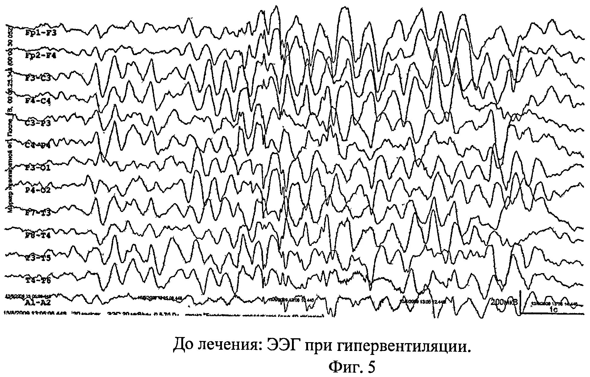 Ээг владивосток. ЭЭГ при разных психических расстройствах. Норма ЭЭГ В 6 лет. ЭЭГ головного мозга нормальные показатели у ребенка. График ЭЭГ здорового человека 30 лет.