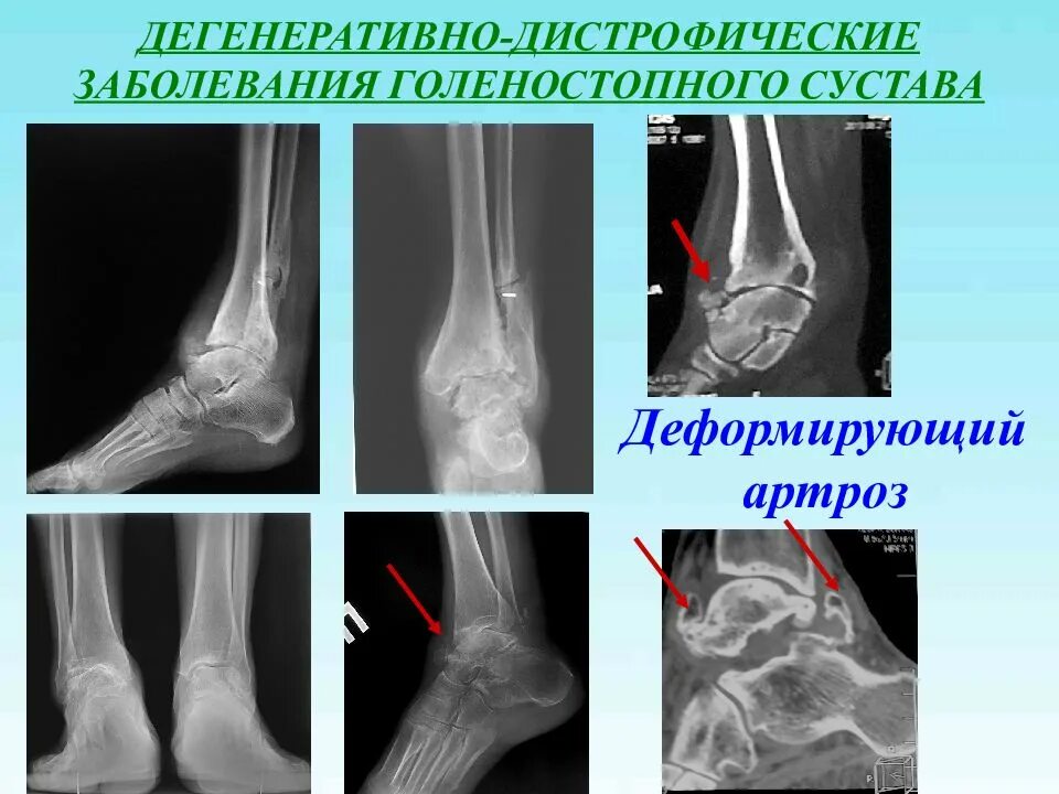 Артрит голеностопа на рентгене. Ревматоидный артрит голеностоп снимок. Деформирующий артроз голеностопного сустава рентген. Артрит голеностопного сустава рентген.