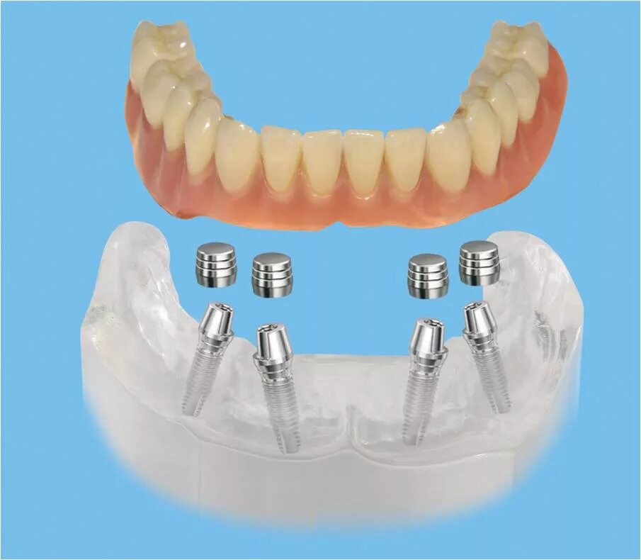 Несъёмный мостовидный протез челюсти. Протез на 2 имплантатах на нижней челюсти. Аттачмент Osstem. Балка на имплантатах аттачмент mk1. Как крепятся съемные