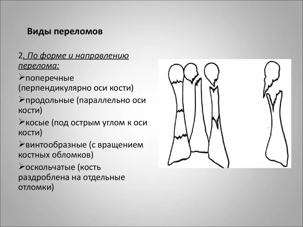 Два типа перелома. Классификация переломов по линии перелома. переломы по форме и направлению. поперечный вид перелома.