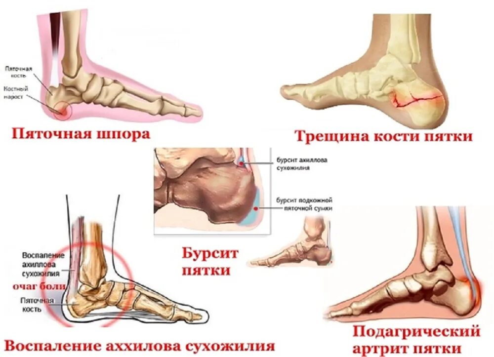 Почему болят ступни. Болит внутренняя часть пятки сбоку. Болит пяточная кость сзади причины. Костная шпора пяточная. Болит пятка при ходьбе сбоку.