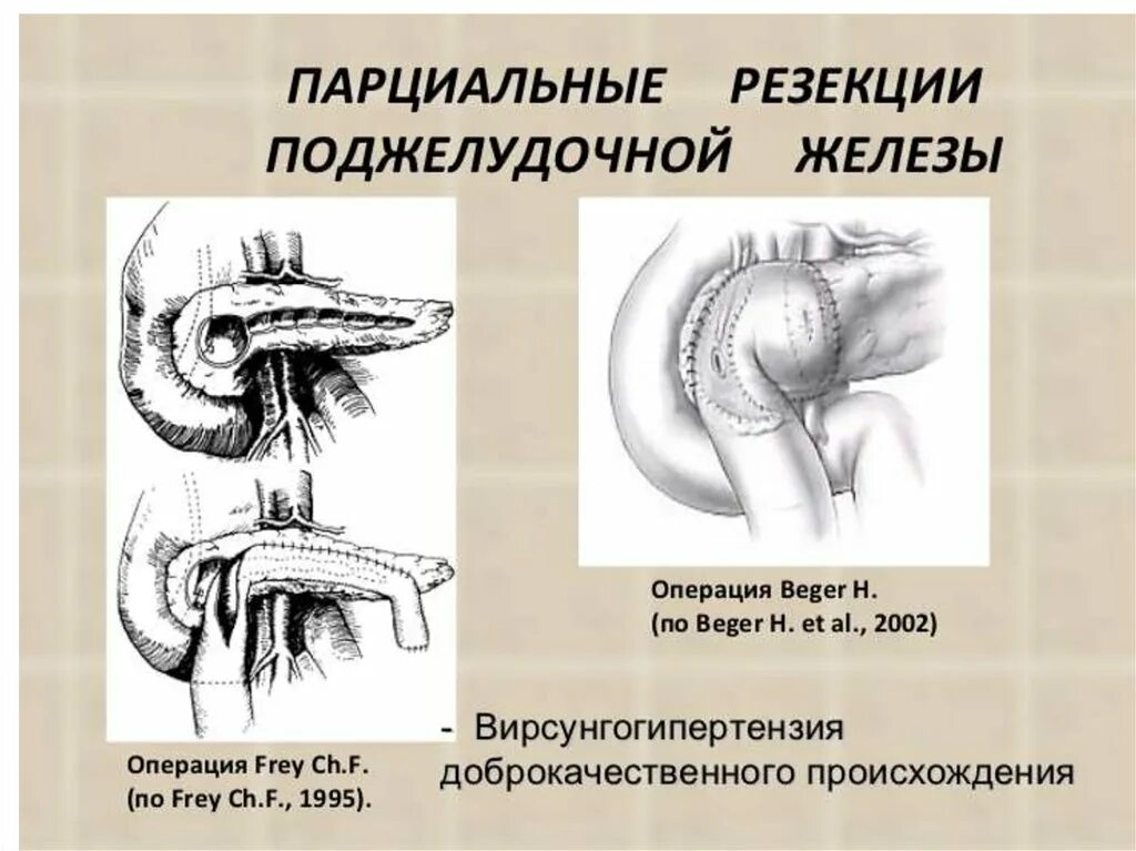 Поджелудочная железа панкреатит операция. Операция Бегера на поджелудочной железе схема. Операция Бегера на поджелудочной железе. Операция Фрея на поджелудочной железе. Резекция головки поджелудочной железы схема.