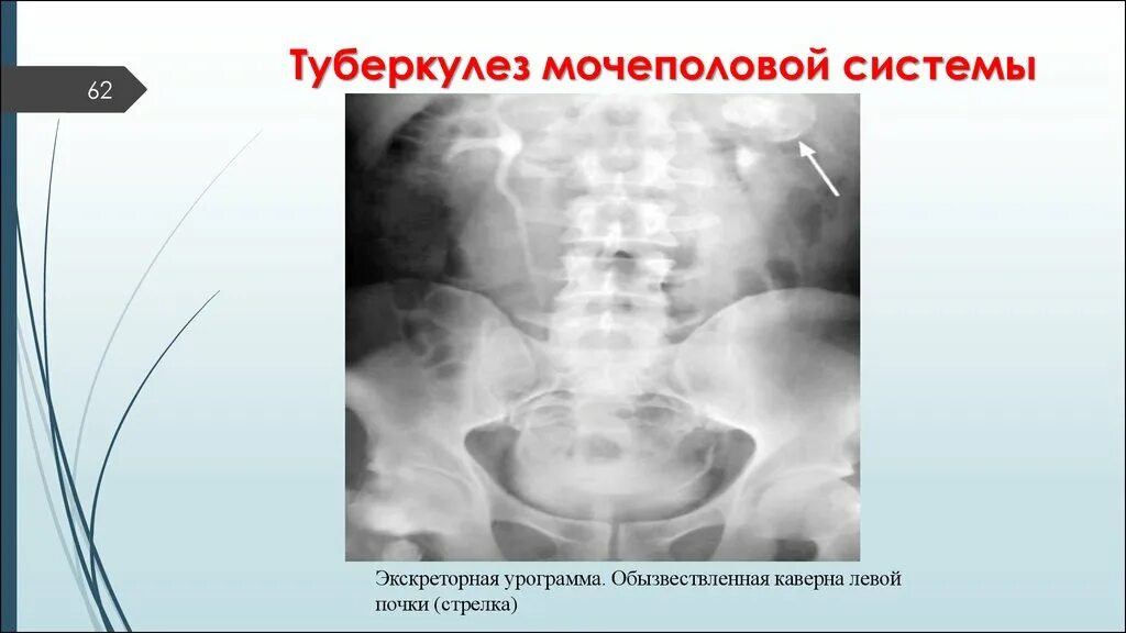 Туберкулез мочевой системы. Поликавернозный туберкулез почки. Туберкулёз мочеполовой системы. Туберкулез органов мочеполовой системы.