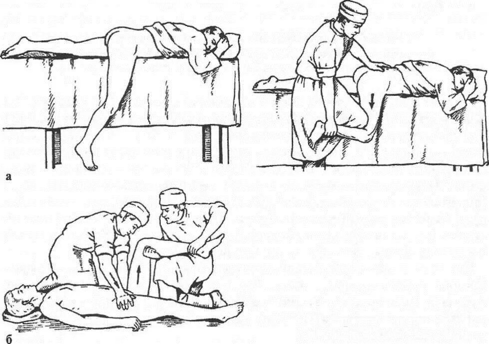 Вправление вывиха бедра по Джанелидзе. Вправление вывиха бедра методом Джанелидзе. Вправление вывиха тазобедренного сустава по Джанелидзе. Метод Джанелидзе вправление бедра. Симптом байкова