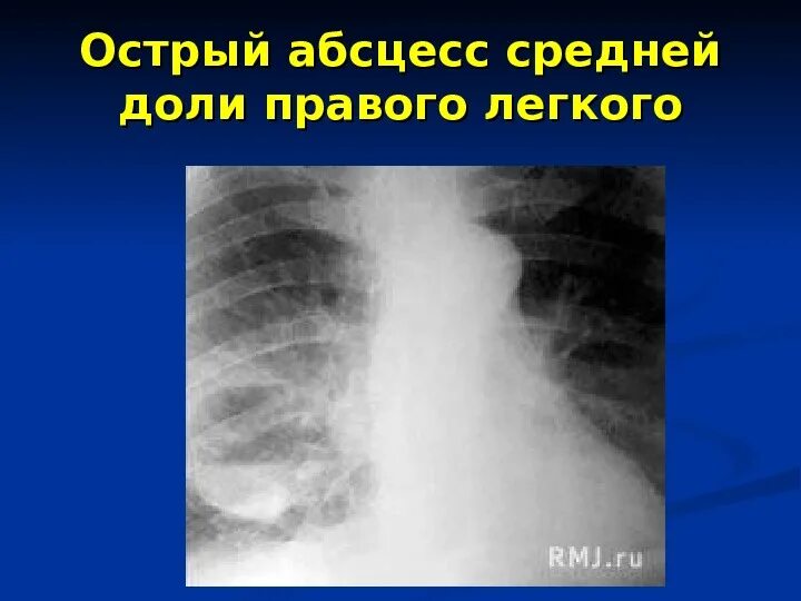 Постпневмонический абсцесс. Абсцесс правого легкого. Абсцесс средней доли правого легкого. Множественный абсцесс легкого. 1 абсцесс легкого