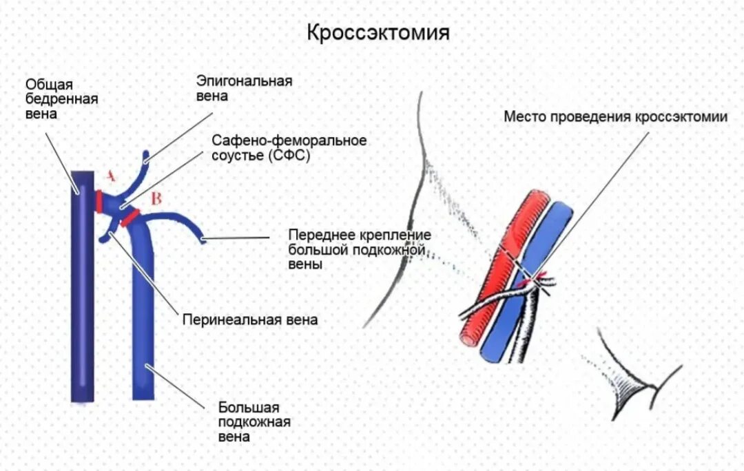 Кроссэктомия этапы операции. Бедренная вена кроссэктомия. Кроссэктомия троянова тренделенбурга. Флебэктомия бпв нижних конечностей. Кроссэктомия операция троянова тренделенбурга.