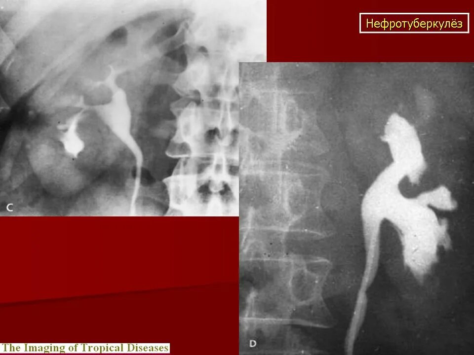 Туберкулез мочевой системы. Туберкулез почек рентгенодиагностика. Туберкулез почки рентген. Туберкулез мочевого пузыря. Туберкулез мочевого пузыря рентген.