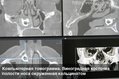 Как удаляют инородные тела попавшие в нос
