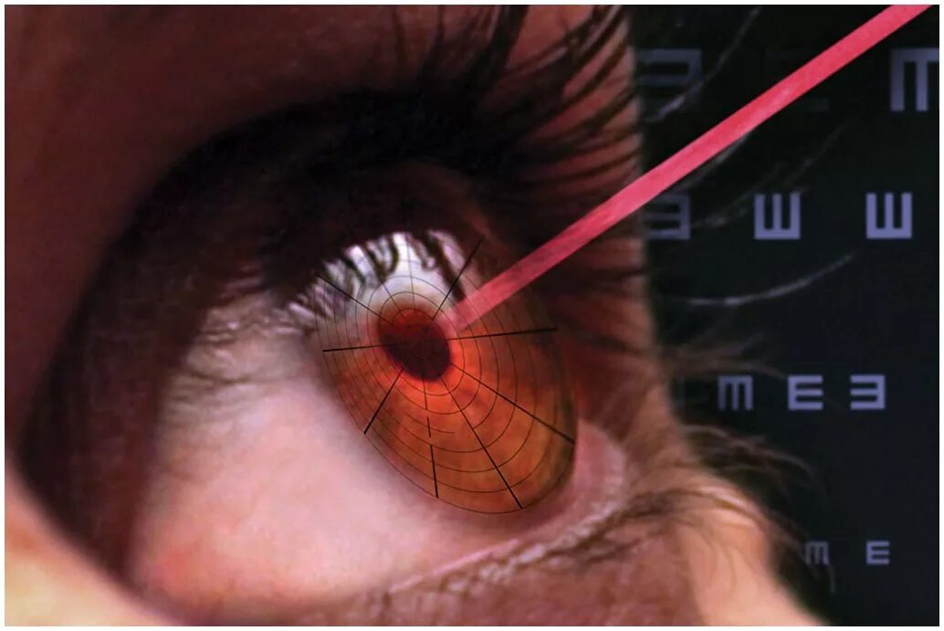 Лечение глаз после операция. Лазеры в офтальмологии хирургии. Лазер в медицине зрение.