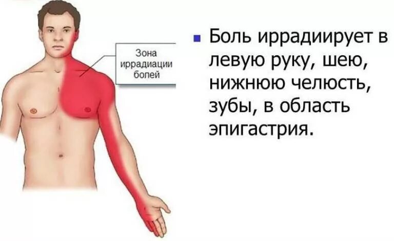 Боль давит. Зоны иррадиации боли при стенокардии. Локализация боли при стенокардии. Типичная локализация боли при стенокардии. Локализация боли при ИБС.