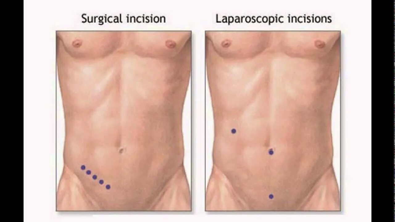 Appendicitis - Simple Patient Information - YouTube