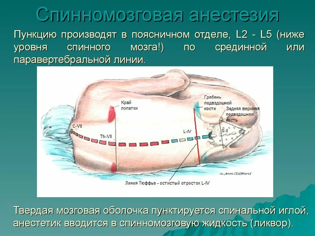 Люмбальная пункция уровень проведения. Спинальная анестезия ориентиры. Спинномозговая анестезия алгоритм. Спинномозговая анестезия оболочки. Осложнения после пункции