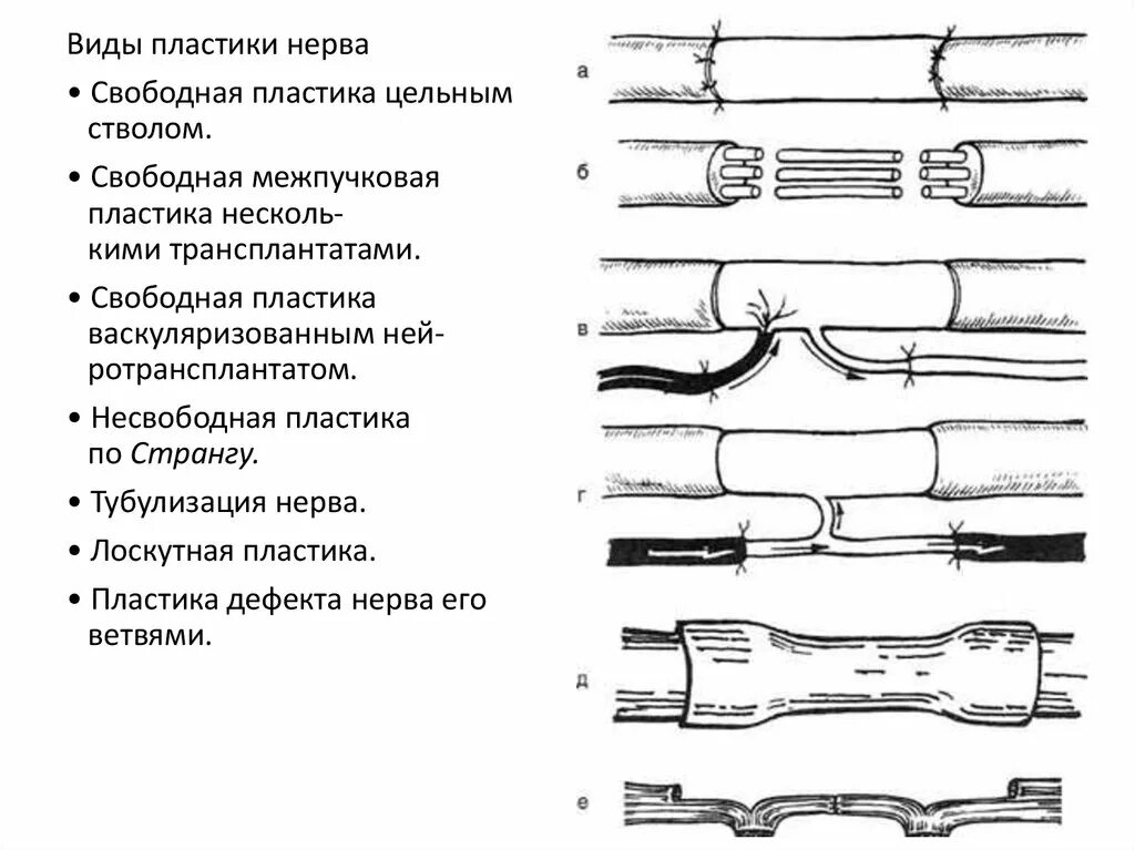 Пластика дефектов периферических нервных стволов:. Формы повреждения нерва. Методика сшивания нерва схема. Восстановление нервов после операции