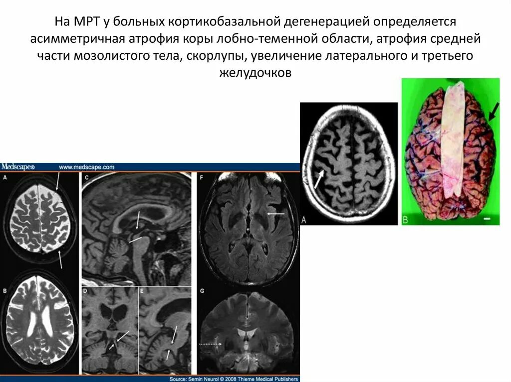 Дегенерация головного. Кортикобазальная дегенерация. Кортико базальная дегенерация. Кортико-базальная дегенерация мрт. Кортикобазальная дегенерация мозг.