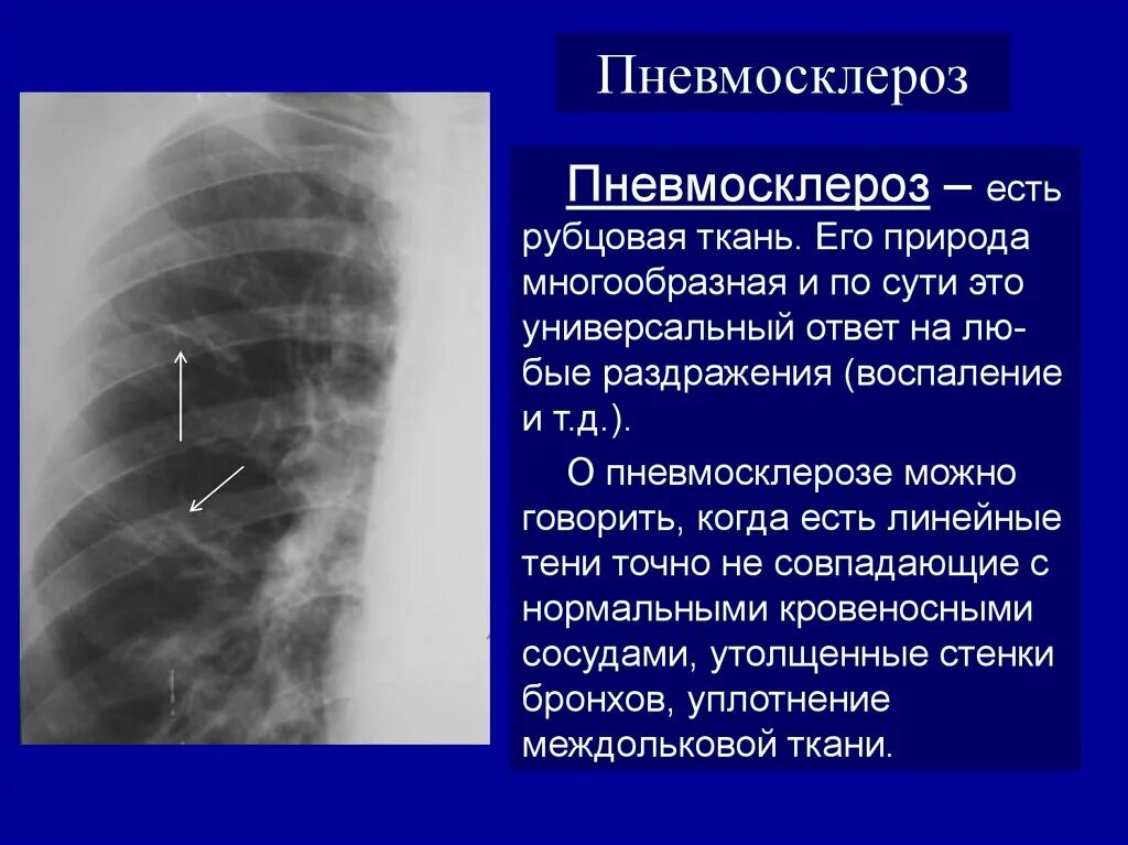 Умеренные фиброзные изменения. Пневмосклероз легких это на рентгене лёгких. Диффузный пневмосклероз рентген. Пневмосклероз рентген признаки. Рентген признаки пневмофиброза.