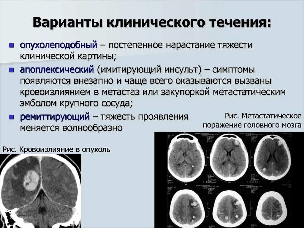 Опухоли головного мозга классификация. Классификация опухолей головы. Типы течения опухолей головного мозга. Классификация глиом головного мозга. Диагноз опухоли головного