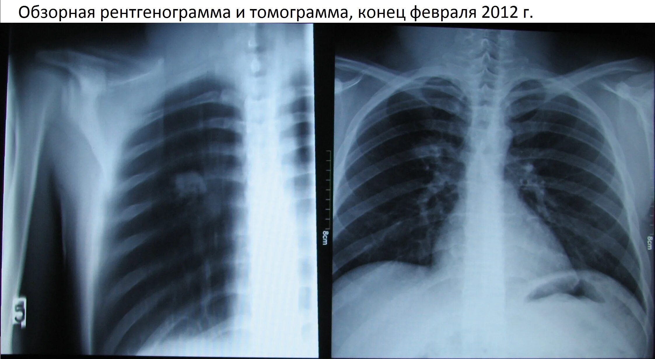 Туберкулез легкого рентгенограмма. Рентген легких туберкулез снимки. Легкие туберкулез рентген. Туберкулёз рентгенограмма.