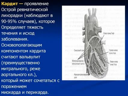 Острый ревматический кардит