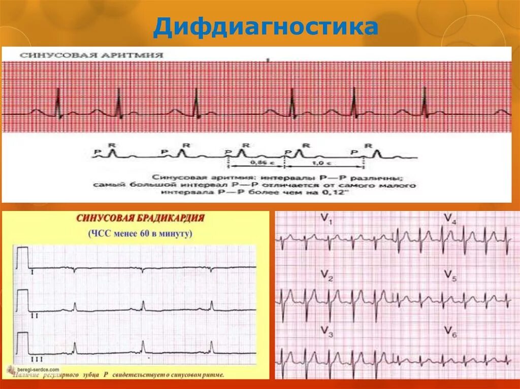 Синусовая тахикардия вертикальное. ЭКГ брадикардия синусовый ритм. Синусовая брадикардия на ЭКГ. Выраженная синусовая брадикардия на ЭКГ. Синусовая аритмия брадикардия.