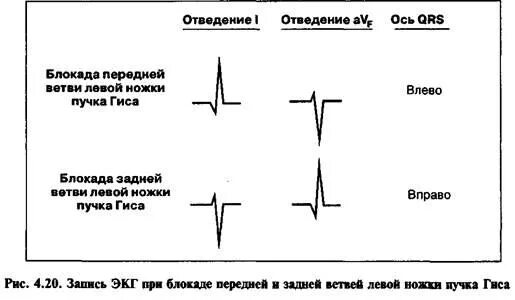 Блокада задней ножки. Блокада передней ветви ЛНПГ на ЭКГ. Блокада левой передней ветви на ЭКГ. Блокада передней верхней ветви левой ножки. Блокада передней ветви левой ножки на ЭКГ.