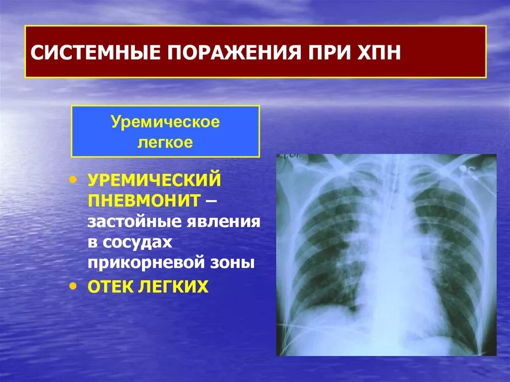 Уремический пневмонит. Поражение легких при ХПН. Изменения в легких при ХПН. Уремический отек легких. Застойные изменения в легких