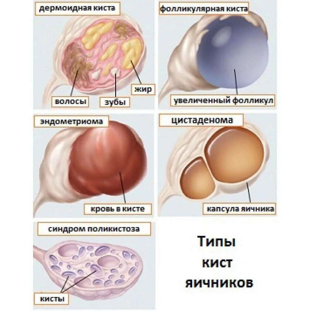 СТО Киа. Опухоль в капсуле