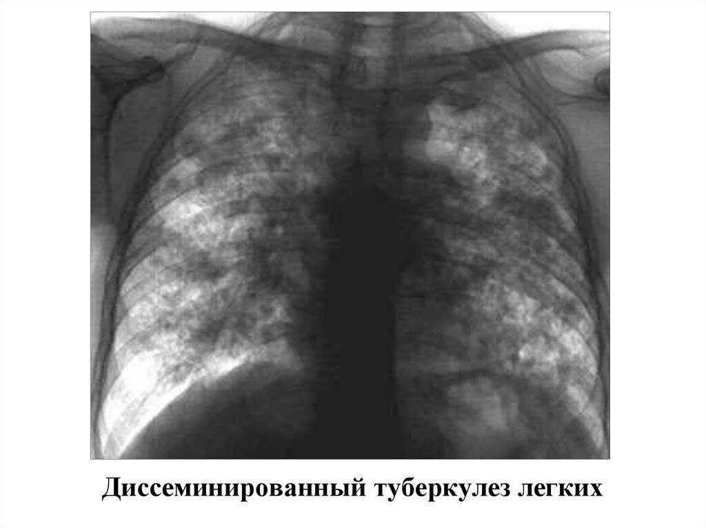 Старый туберкулез. Диссеминированный туберкулез на рентгенограмме. Подострый диссиминированный туберкулёз рентген. Хронический диссеминированный туберкулез легких рентген. Подострый диссеминированный туберкулез рентген.