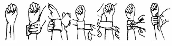 Техника наложения давящей повязки при кровотечении. Наложение давящей повязки при кровотечении. Давящая повязка при венозном кровотечении. Венозное кровотечение наложение давящей повязки.