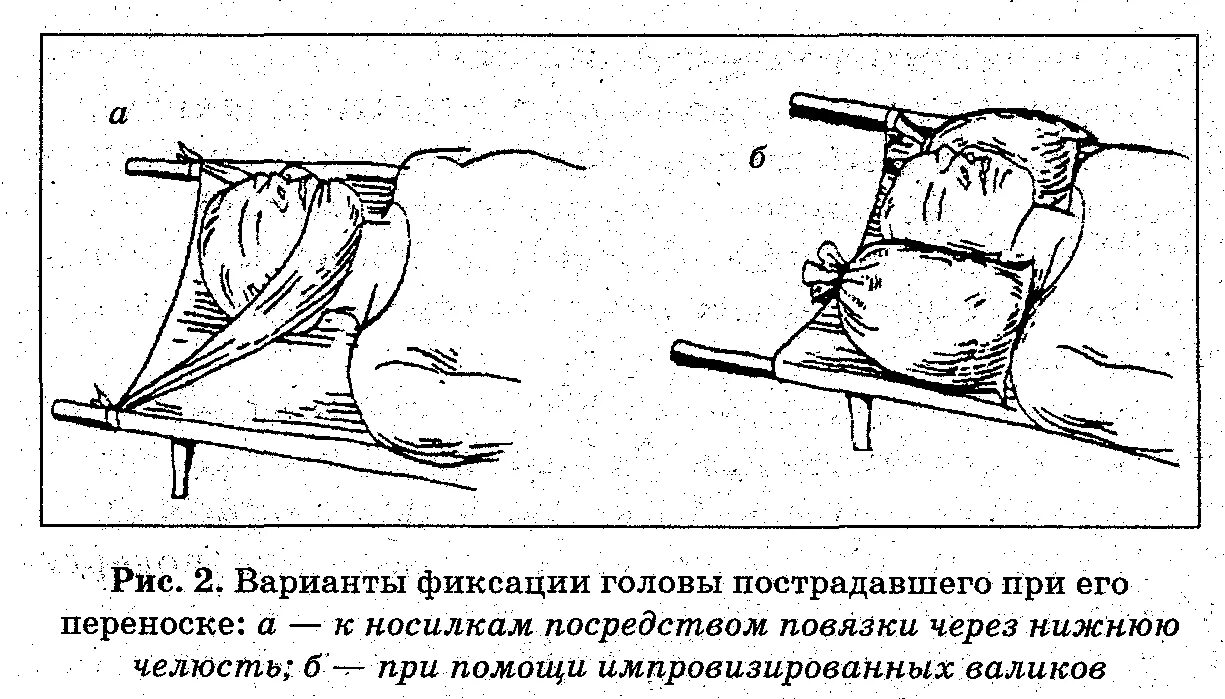 Положение при ранении головы. Фиксация головы при чмт. транспортная иммобилизация при чмт. транспортная иммобилизация при закрытой черепно-мозговой травме. перемещение пациента с черепно мозговой травмой.