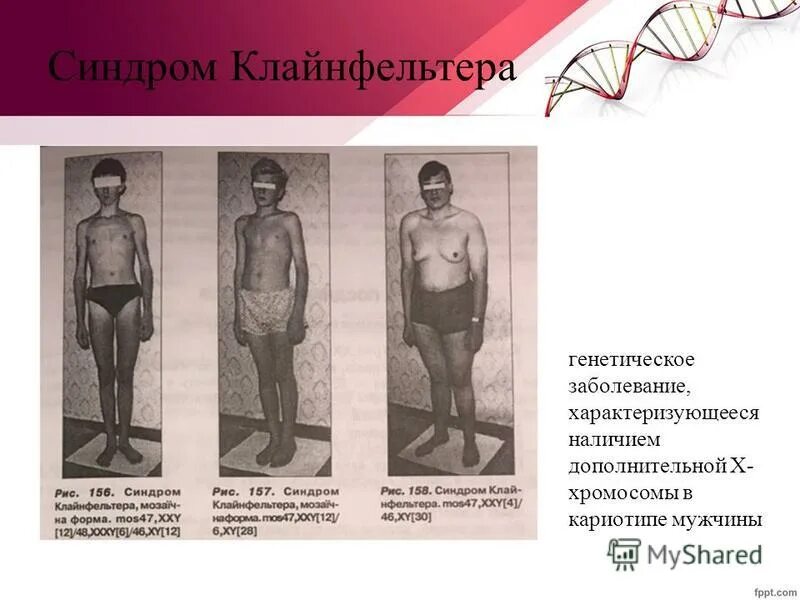 Клайнфельтера синдром мозаичный Тип. Синдром Клайнфельтера факторы риска. Синдром Клайнфельтера генетика. Синдром Клайнфельтера клинические проявления. Синдром клайнфельтера наследственное